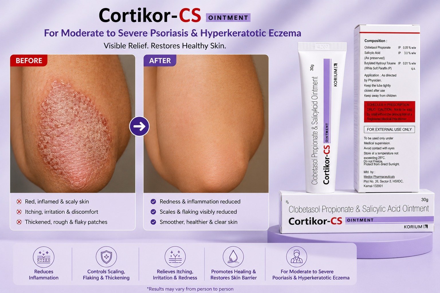 Cortikor CS Clobetasol Propionate & Salicylic Acid Ointment